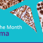 Cell Marque Disease of the Month – Lymphoma