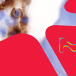 Lymphomas and Leukaemias Webinar